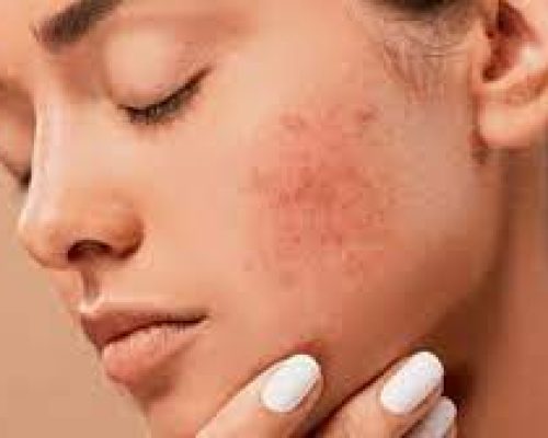 Treatment-for-Skin-Diseases